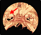 左中大脳動脈瘤